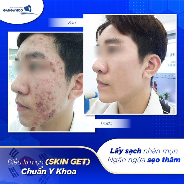 cach tri mun dau den o mui 4