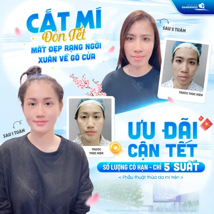 Cắt mí đón tết mắt đẹp rạng ngời xuân về gõ cửa ưu đãi cận tết giá siêu yêu thương