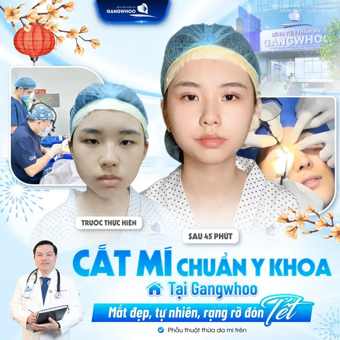 Cắt mí chuẩn y khoa tại bệnh viện thẩm mỹ Gangwhoo mắt đẹp, mí xinh rạng rỡ đón tết 