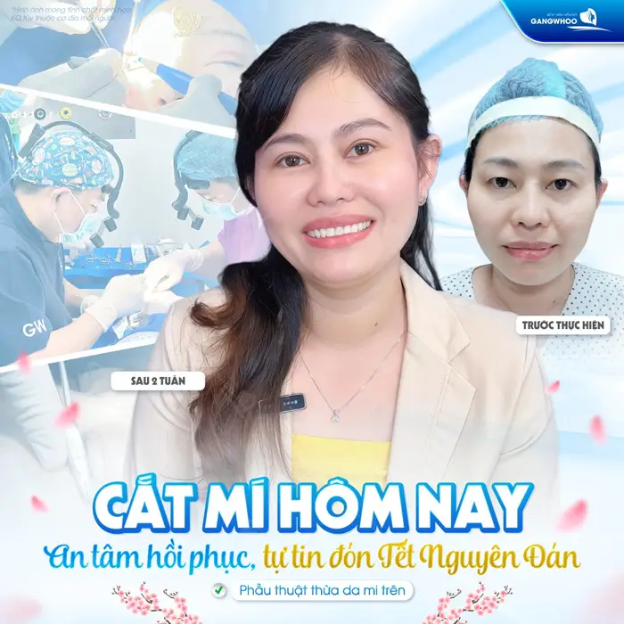 Cắt mí hôm nay, an tâm hồi phục tự tin đón tết Nguyên Đán thêm tự tin và rạng rỡ ánh nhìn 