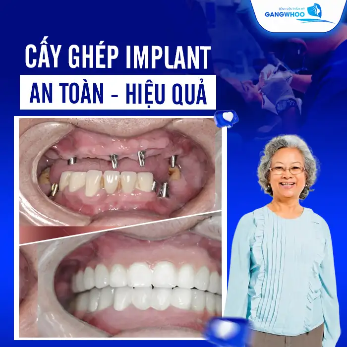 Người Cao Tuổi Cấy Ghép Implant Được Không? Bác Sĩ Giải Đáp 4 Cấy Ghép Implant Được Không