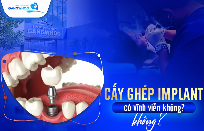 cay ghep implant co vinh vien khong