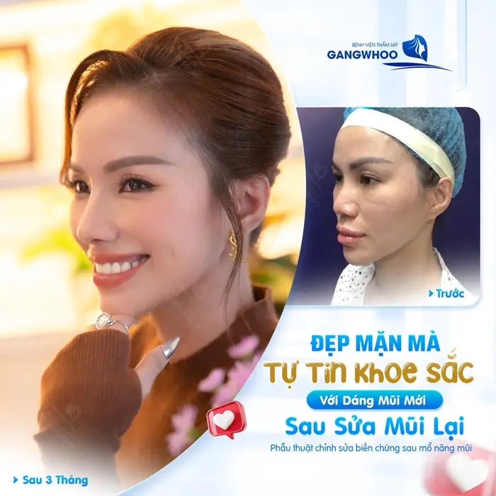 Đẹp mặt mà tự tin khoe sắc với dáng mũi mới sau sửa mũi lại 