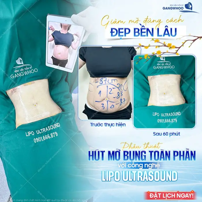 Giảm mỡ đúng cách đẹp bền lâu chỉ sau 60 phút phẫu thuật hút mỡ bụng toàn phần công nghệ Lipo Ultrasound