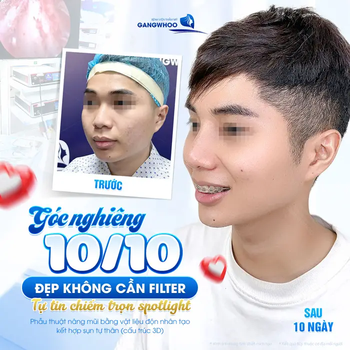 Góc nghiêng 10 điểm tự tin rạng rỡ sau phẫu thuật nâng mũi tại bệnh viện thẩm mỹ Gangwhoo 