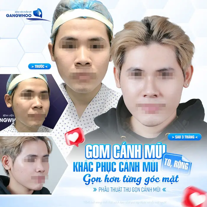 Gom cánh mũi khắc phục cánh mũi gọn hơn từng góc mắt khắc phục cánh mũi to và rộng hiệu quả