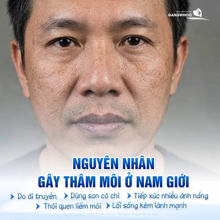 4 Phương Pháp Khử Thâm Môi Nam Giới Hiệu Quả Chuẩn Men