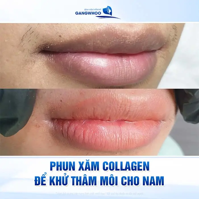 4 Phương Pháp Khử Thâm Môi Nam Giới Hiệu Quả Chuẩn Men