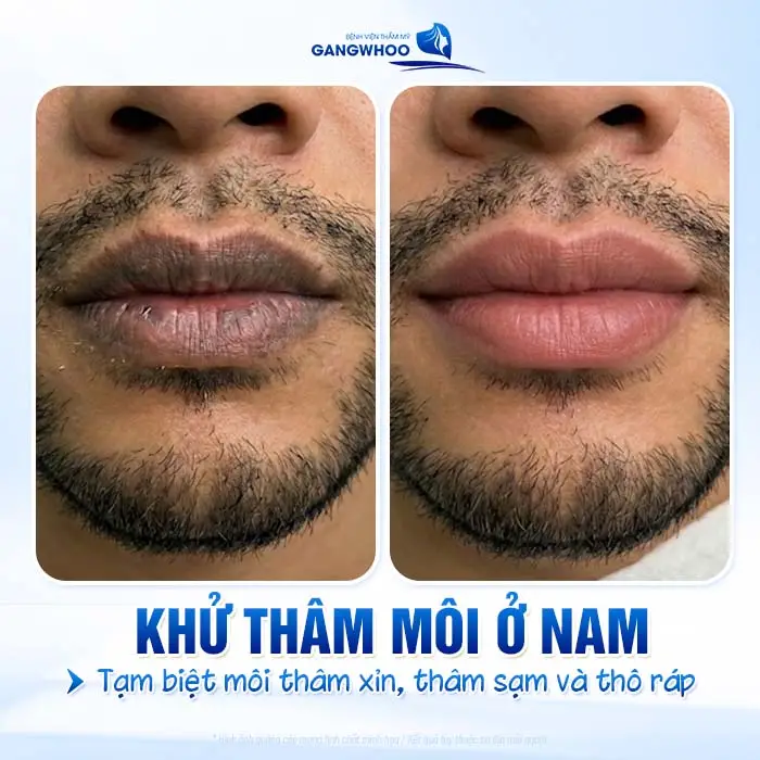 4 Phương Pháp Khử Thâm Môi Nam Giới Hiệu Quả Chuẩn Men