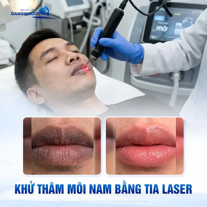 4 Phương Pháp Khử Thâm Môi Nam Giới Hiệu Quả Chuẩn Men