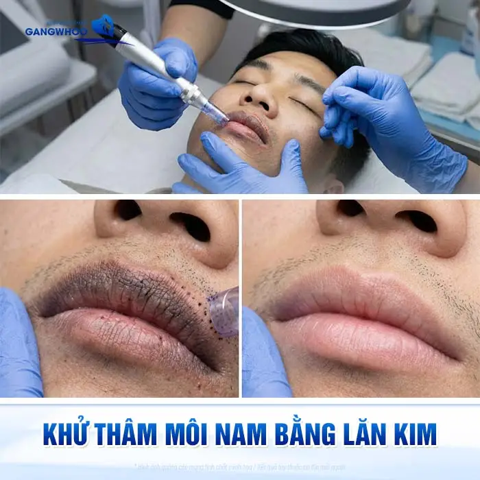 4 Phương Pháp Khử Thâm Môi Nam Giới Hiệu Quả Chuẩn Men