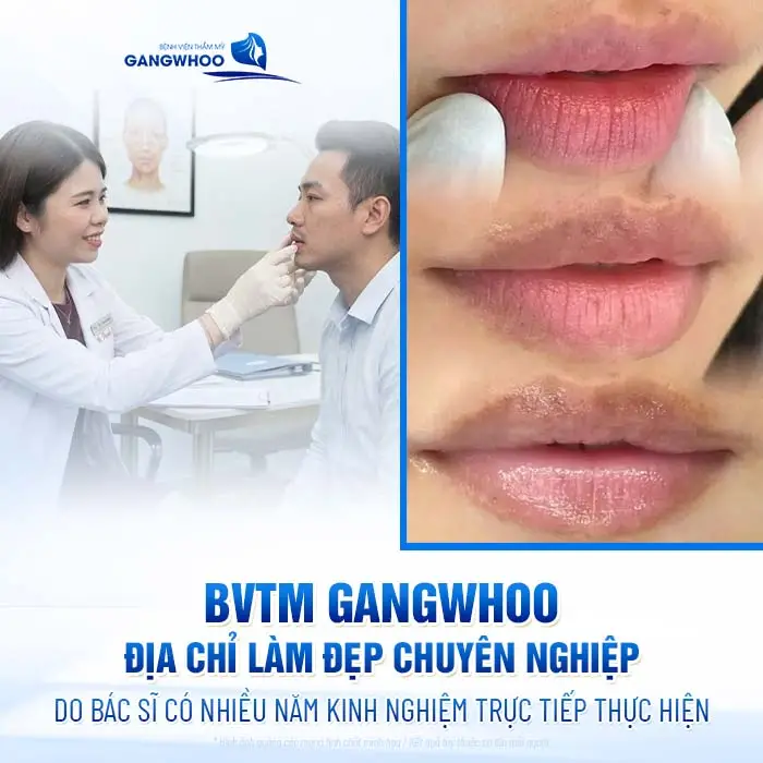 4 Phương Pháp Khử Thâm Môi Nam Giới Hiệu Quả Chuẩn Men