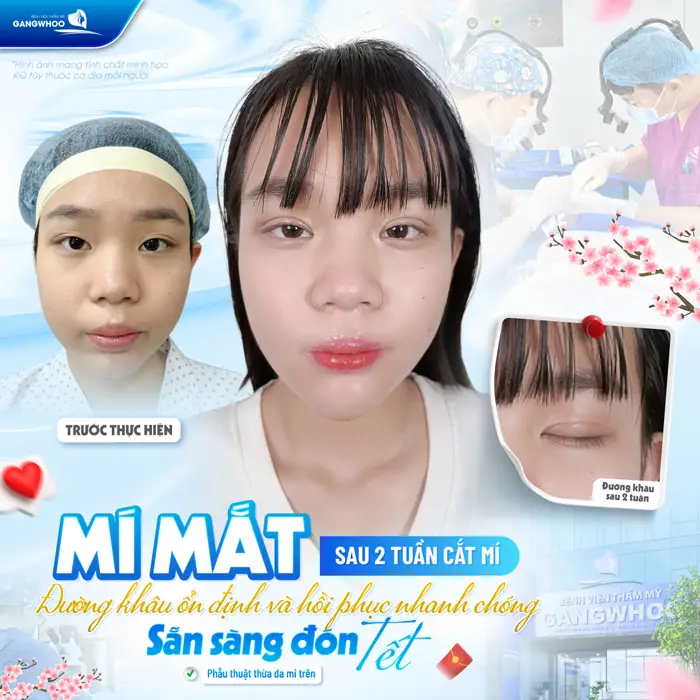Mí mắt sau 2 tuần đường khâu đã ổn định và hồi phục nhanh chóng 