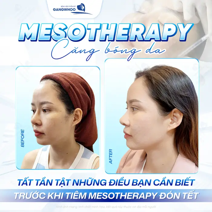 Điều trị nám bằng công nghệ Mesotherapy căng bóng da đẹp xuất sắc trẻ hóa đón năm mới căng sang