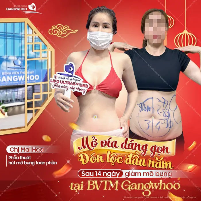 Mở vía dang gọn đón lộc đầu xuân sau 14 ngày giảm mỡ bụng tại BVTM Gangwhoo