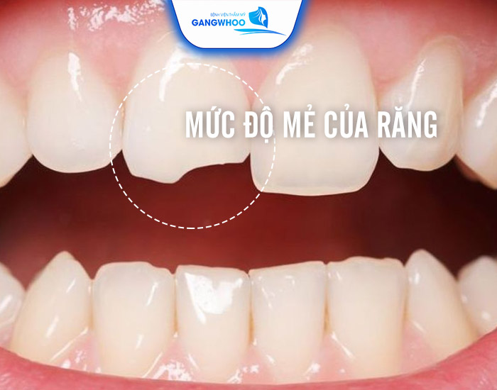 Trám Răng Cửa Bị Mẻ Bao Nhiêu Tiền? Bảng Giá Mới - 2025 9 Trám Răng Cửa Bị Mẻ Bao Nhiêu Tiền