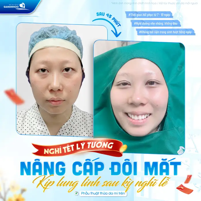 Nâng cấp đôi mắt kịp đẹp lung linh đón lễ lớn rạng sức sống