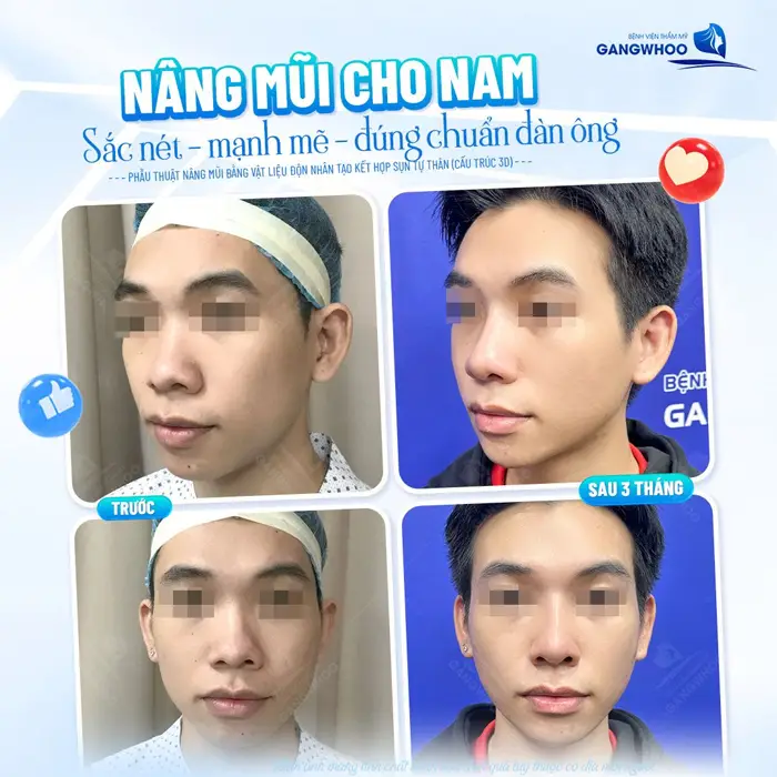 Phẫu thuật nâng mũi bằng vật liệu độn nhân tạo kết hợp sụn tự thân mũi cao đẹp, sắc nét