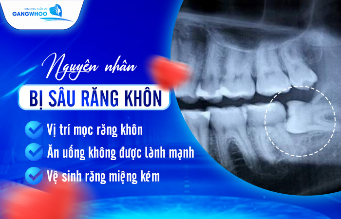 Răng Khôn Bị Sâu Có Trám Được Không? Nên Trám Hay Nhổ Răng 7 Răng Khôn Bị Sâu Có Trám Được Không