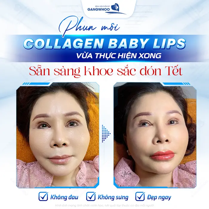 Phun Môi Đón Tết - Bí Quyết Sở Hữu Đôi Môi Quyến Rũ Chào Năm Mới 3 Phun môi collagen baby lips vừa thực hiện xong sẵn sàng khoe sắc đón Tết đẹp ngay mà không đau đớn