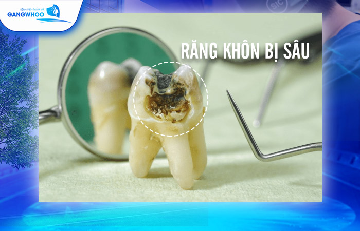 Răng Khôn Bị Sâu Có Trám Được Không? Nên Trám Hay Nhổ Răng 8 Răng Khôn Bị Sâu Có Trám Được Không