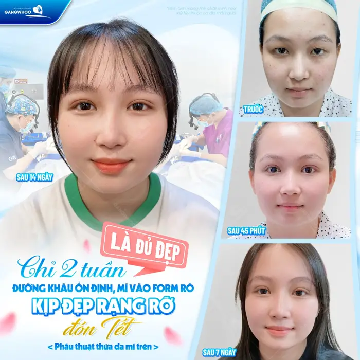 Chỉ cần 2 tuần đôi mắt đã ổn định và vào form cơ bản tự tin với đường mí ổn định và vào form đón tết 
