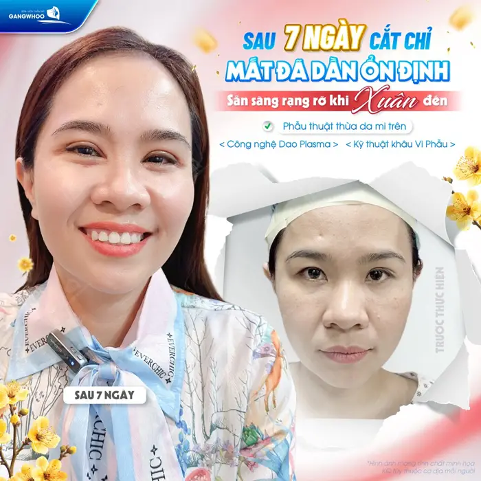 Sau 7 ngày cắt chỉ mắt đã ổn định sẵn sàng rạng rỡ mừng xuân đến 