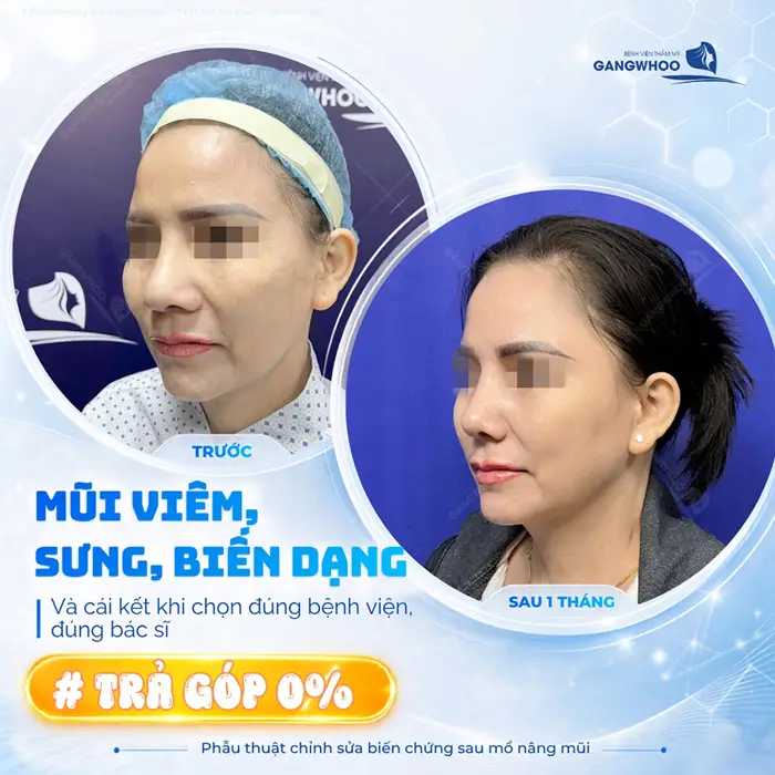 Kết quả sau 1 tháng khắc phục tình trạng mũi viêm, sưng và biến dạng không lo áp lực chi phí 