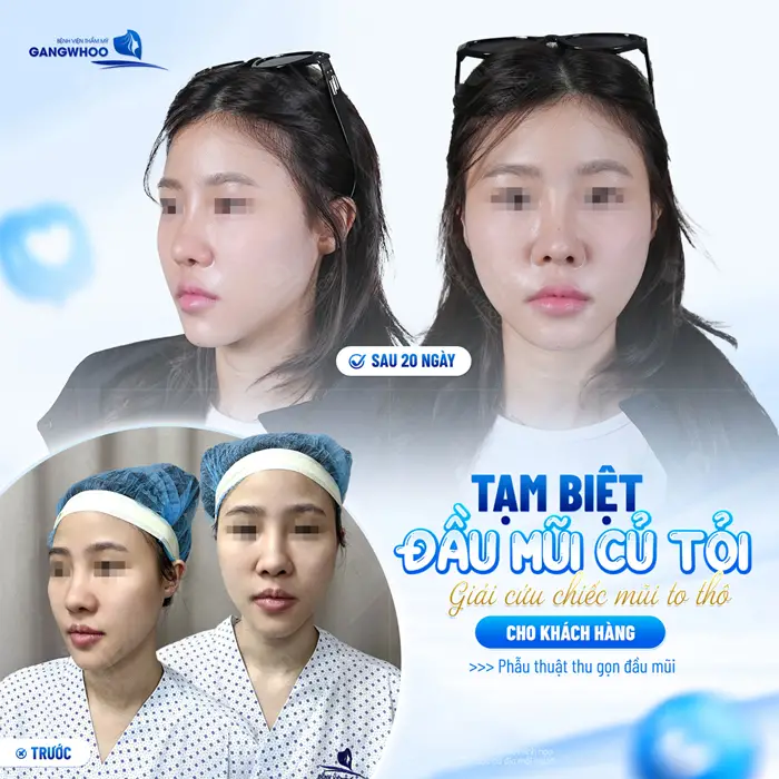 Tạm biệt đầu mũi củ tỏi khách hàng thoát kiếp sống chung với đầu mũi to và thô bè hiệu quả