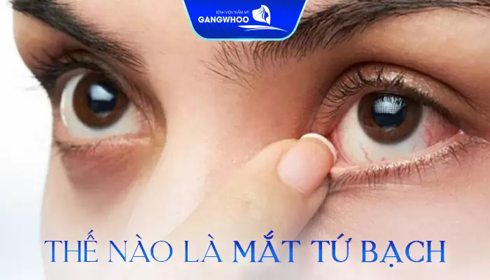 Mắt tứ bạch là đôi mắt có đặc điểm phần tròng đen quá nhỏ và thường nằm giữa vùng trắng của mắt