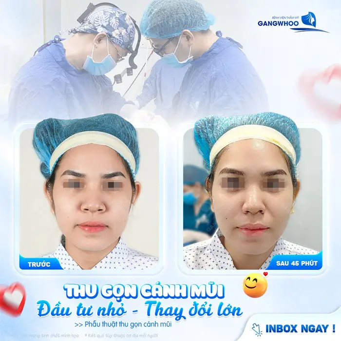 Thu gọn cánh mũi đầu tư nhỏ, thay đổi lớn giúp gương mặt cân đối và hài hòa hơn