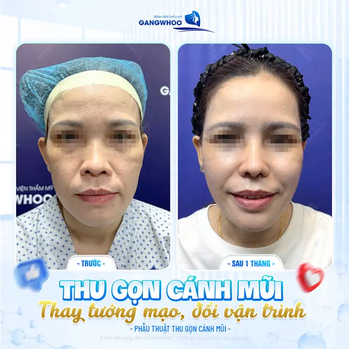 Thu gọn cánh mũi thay đổi tướng số, gương mặt thêm hài hòa và cân đối với nhan sắc hiện tại