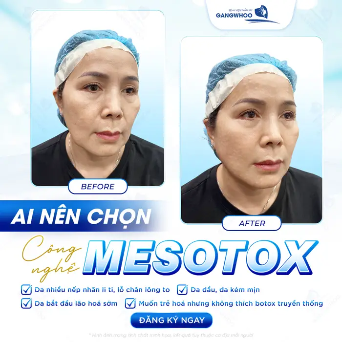 Trẻ hóa da với công nghệ Mesotox khắc phục khuyết điểm lão hóa an toàn, nhẹ nhàng và hiệu quả cao