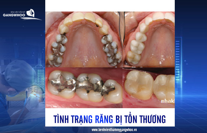 Trám Răng Có Đau Không