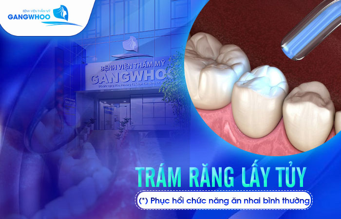 Trám Răng Lấy Tủy Là Gì? Ưu Nhược Điểm Và Quy Trình 10 Trám Răng Lấy Tủy