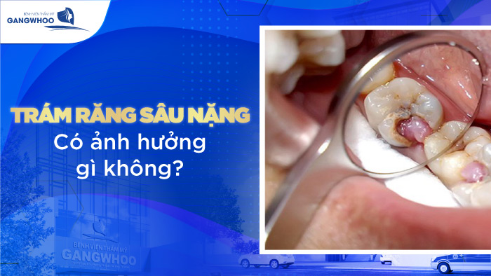 Có Nên Trám Răng Sâu Nặng Không? Thực Hiện Có Đắt Không?