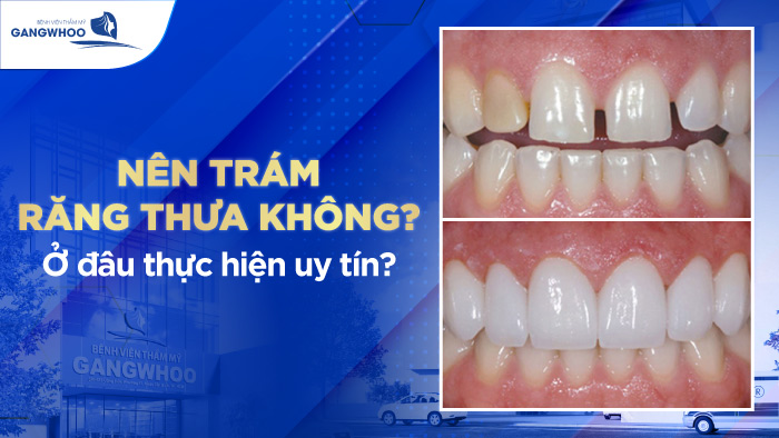 Trám Răng Thưa Được Bao Lâu, Có Duy Trì - Không?