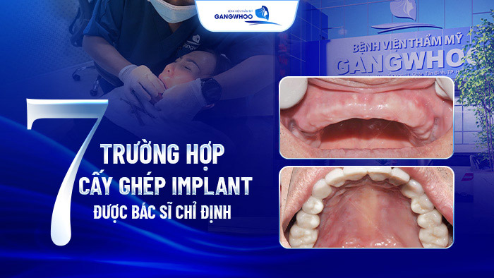 truong hop cay ghep implant 1