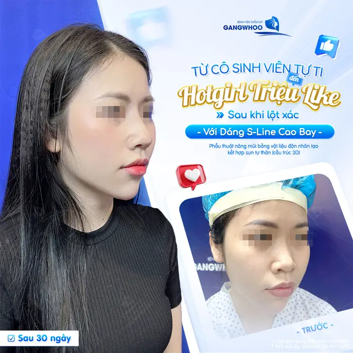 Lột xác diện mạo thăng hạng đến bất ngờ sau phẫu thuật nhan sắc xinh đẹp và sắc nét hơn thấy rõ