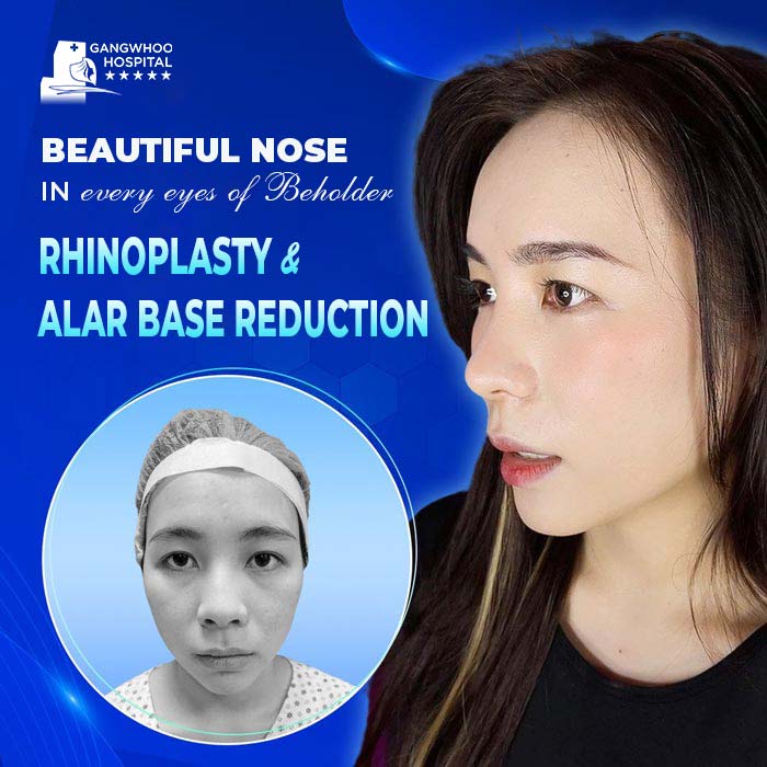 Does Alar Base Reduction Make The Nose Higher? 5 Does Alar Base Reduction Make The Nose Higher?