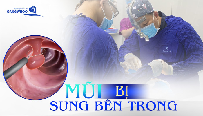 mui bi sung ben trong