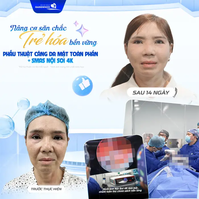 Nâng cơ săn chắc trẻ hóa bền vững sau phẫu thuật căng da mặt toàn phần Smas nội soi 4K