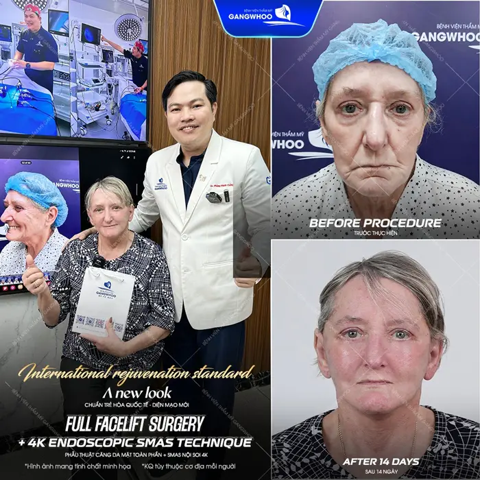 Sau 14 ngày thực hiện căng da mặt toàn phần ứng dụng công nghệ nội soi hiện đại diện mạo đã hoàn toàn lột xác