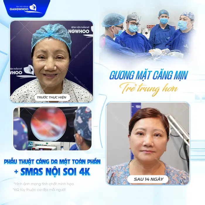 Gương mặt căng mịn trẻ trung hơn sau 14 ngày phẫu thuật đã hoàn toàn khác biệt 