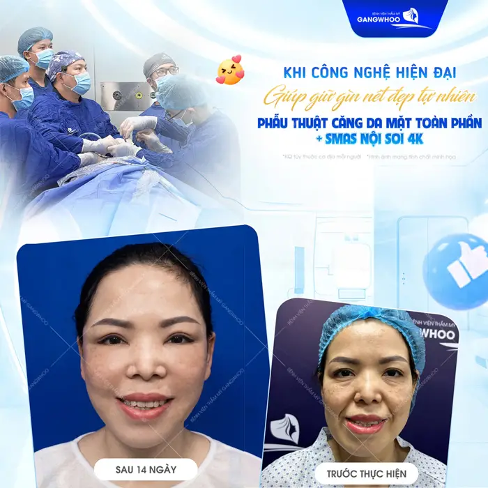 Phẫu thuật căng da mặt toàn phần Smas nội soi 4K với công nghệ hiện đại trẻ hơn, đẹp hơn và rạng rỡ hơn