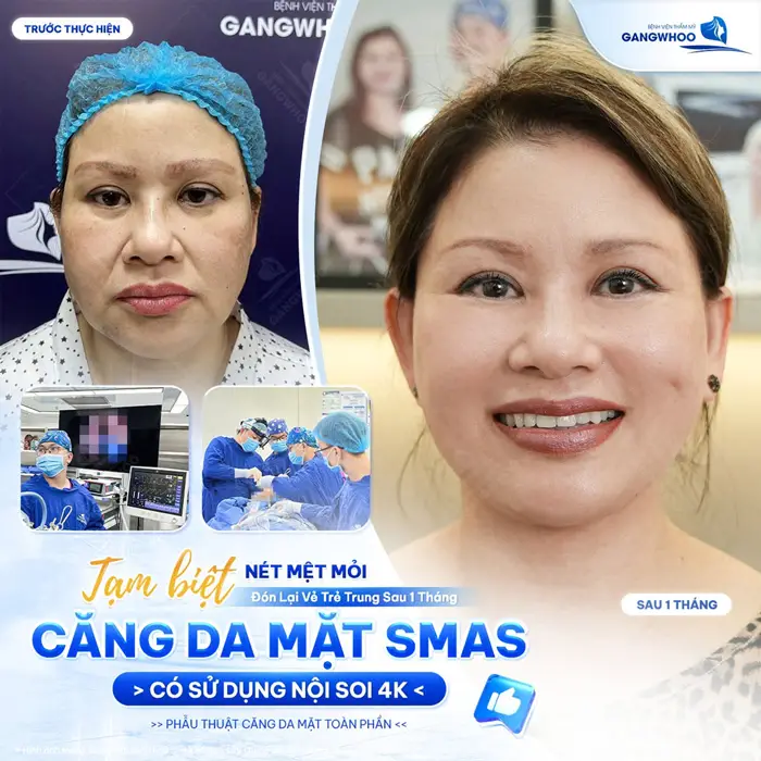 Tạm biệt nét mệt mỏi đón lấy diện mạo trẻ trung sau 1 tháng thực hiện căng da mặt Smas có sử dụng nội soi 4K