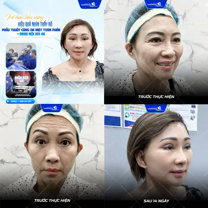 Trẻ hóa trẻ trung hiệu quả nhìn thấy rõ sau phẫu thuật căng da mặt toàn phần Smas nội soi 4K