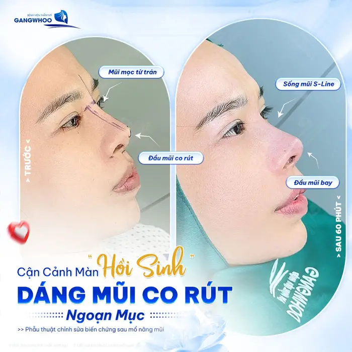 Cận cảnh dáng mũi hồi sinh sau thực hiện điều chỉnh "co rút" khôi phục lại diện mạo hài hòa và thanh thoát cho gương mặt