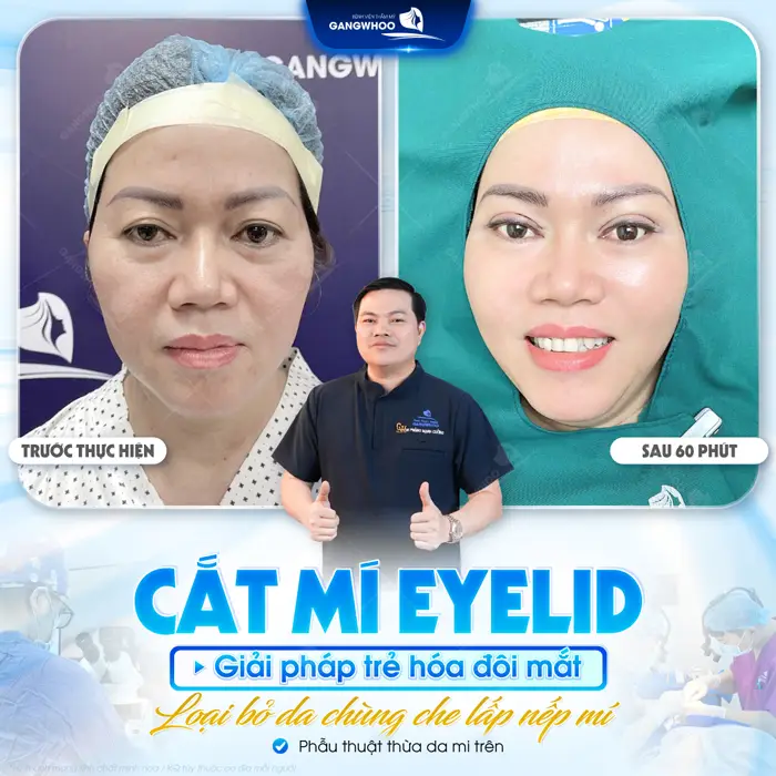 Mở rộng ánh nhìn cải thiện đôi mắt thêm tươi tắn và rạng rỡ một cách an toàn chỉ sau 60 phút thực hiện 