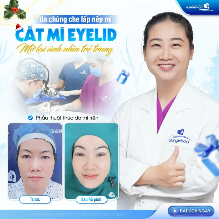 Da chùng che lấp nếp mí cắt mí Eyelid mở lại ánh nhìn trẻ trung đầy xinh đẹp và cuốn hút